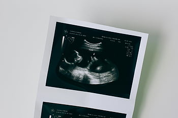 sonogram, close-up shot, pregnancy ultrasound, developing fetus, detailed close-up, ultrasound image, medical imaging, fetal development, pregnancy scan, ultrasound picture, sonogram image
