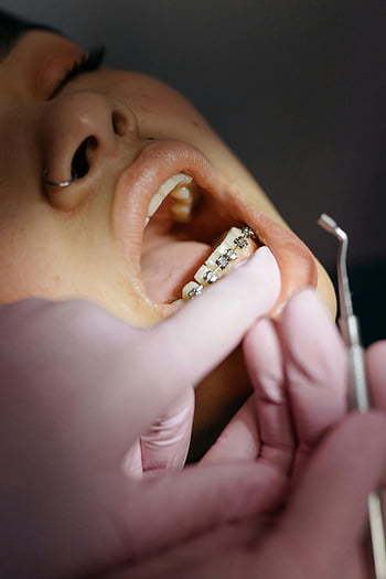 dentist, patient, braces, dental appointment, examining, treatment, teeth, orthodontics, dental care, dental health, gloved hands