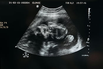 ultrasound, unborn child, pregnancy, healthcare, fetal image, womb scan, clinic ultrasound, prenatal care, medical imaging, fetal development, ultrasound technology