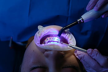 dental treatment, UV light curing, teeth whitening, dental procedure, health care, dental care, dental hygiene, dental health, dental clinic, dental equipment, dental patient