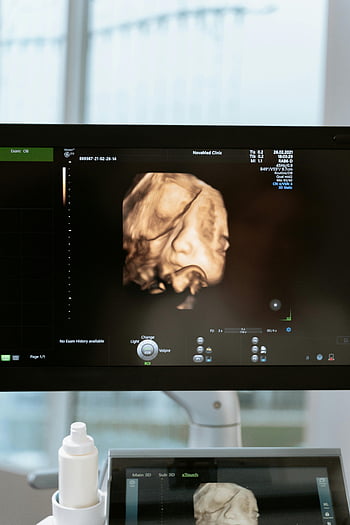 3D ultrasound, fetal scan, medical monitor, clinic setting, prenatal care, medical imaging, ultrasound technology, fetal development, obstetrics, antenatal care, medical examination