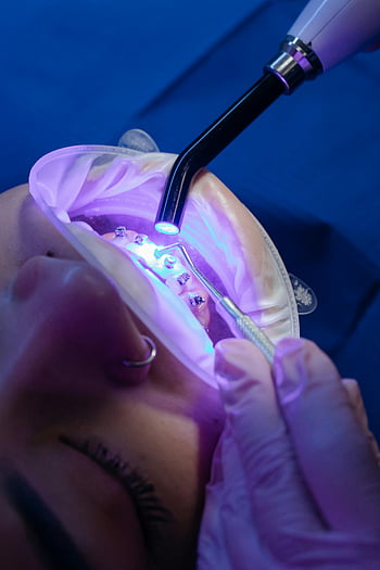 zubní ošetření, uv světlo, šle, ortodontická léčba, detail, zubní postup, zuby, ortodoncie, Péče o zuby, stomatologické vybavení, trpěliví