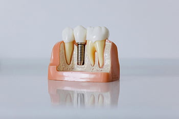 Zubní implantát, detailní záběr, Struktura zubů, vzdělávací model, Podrobný zubní, Implantační model, zubní vzdělávání, zdraví zubů, Péče o zuby, Dentální protetika