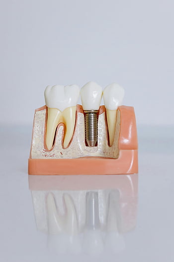 Model dentálního implantátu, detailní záběr, Anatomie zubů, Anatomie gumy, zubní vzdělávání, Podrobný pohled, Zubní implantát, zubní model, Dentální protetika, zdraví zubů, Péče o zuby